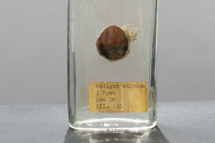 Sample of skin cancer in a human eye in a glass box.